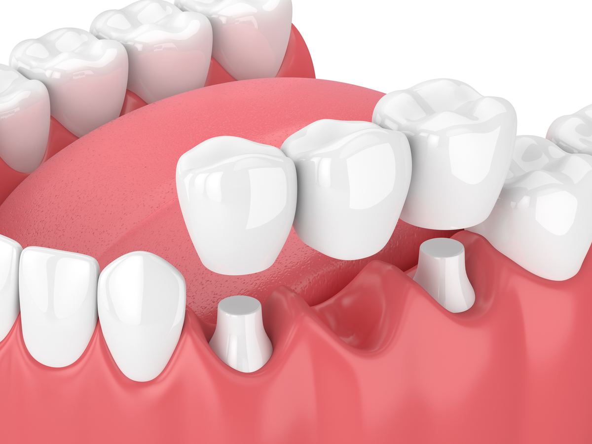 Bridge sur implants