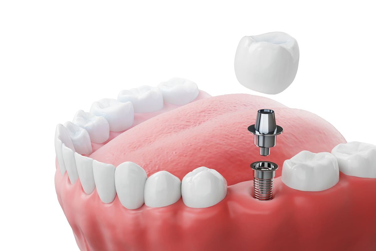 Implants dentaires